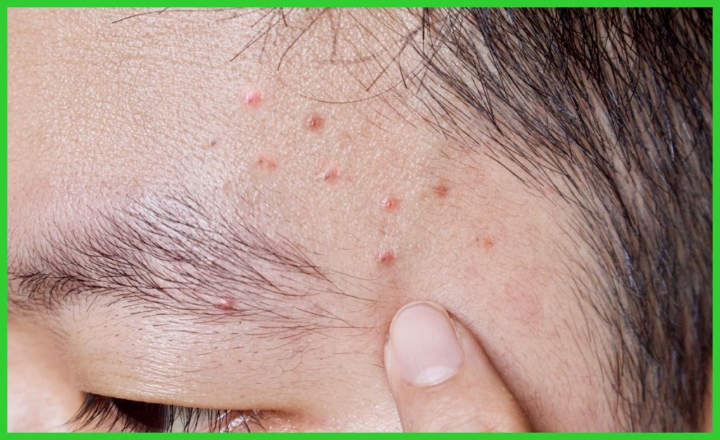 o que causa acne e espinhas
